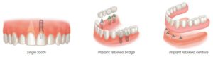 Plum Grove Dental Associates - Dental Implants