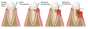 Plum Grove Dental Associates - Periodontal Disease 