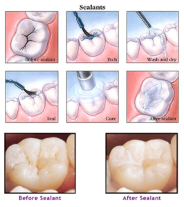 Plum Grove Dental Associates - Sealants