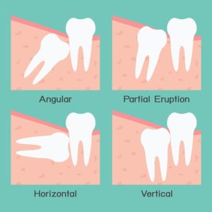 Plum Grove Dental Associates - Wisdom Teeth Removal