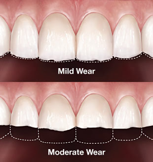teeth worn capped lower short getting dental center them
