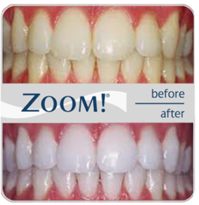 Plum Grove Dental Associates - Whitening - Zoom - Before and After