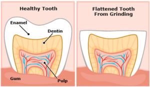 Bruxism illustration damage to a tooth