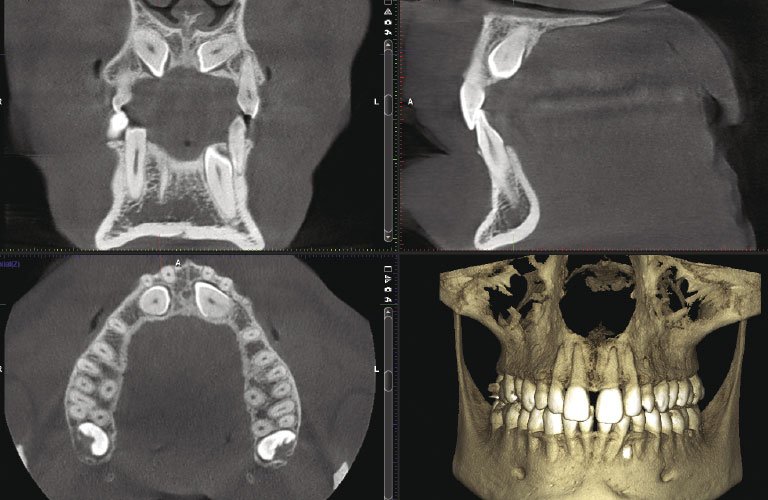 What Is The Dental Code For Cone Beam Ct Scan