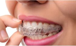Things you should know about clear aligners