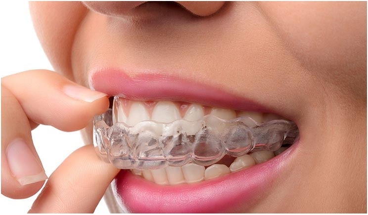 Things you should know about clear aligners